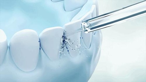 Vantaggi dei fili d'acqua per le lo indossimenti delle parentesi graffe